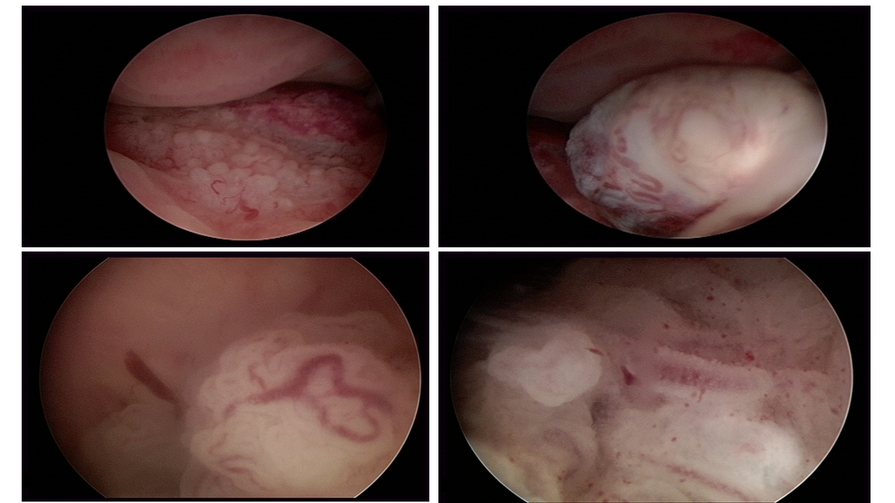 Carcinoma dellendometrio